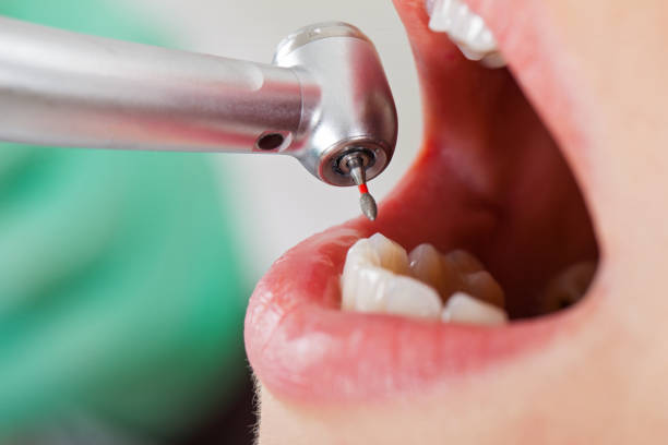 Best Emergency Dental Care for Broken or Chipped Teeth in Seyur, MO